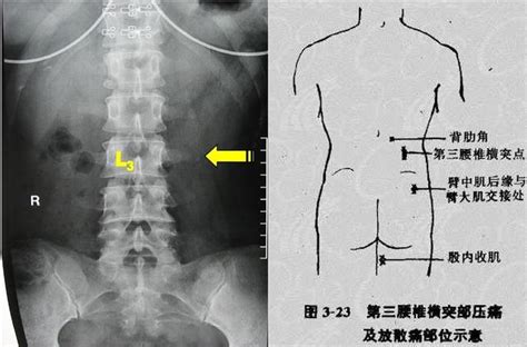 橫腰